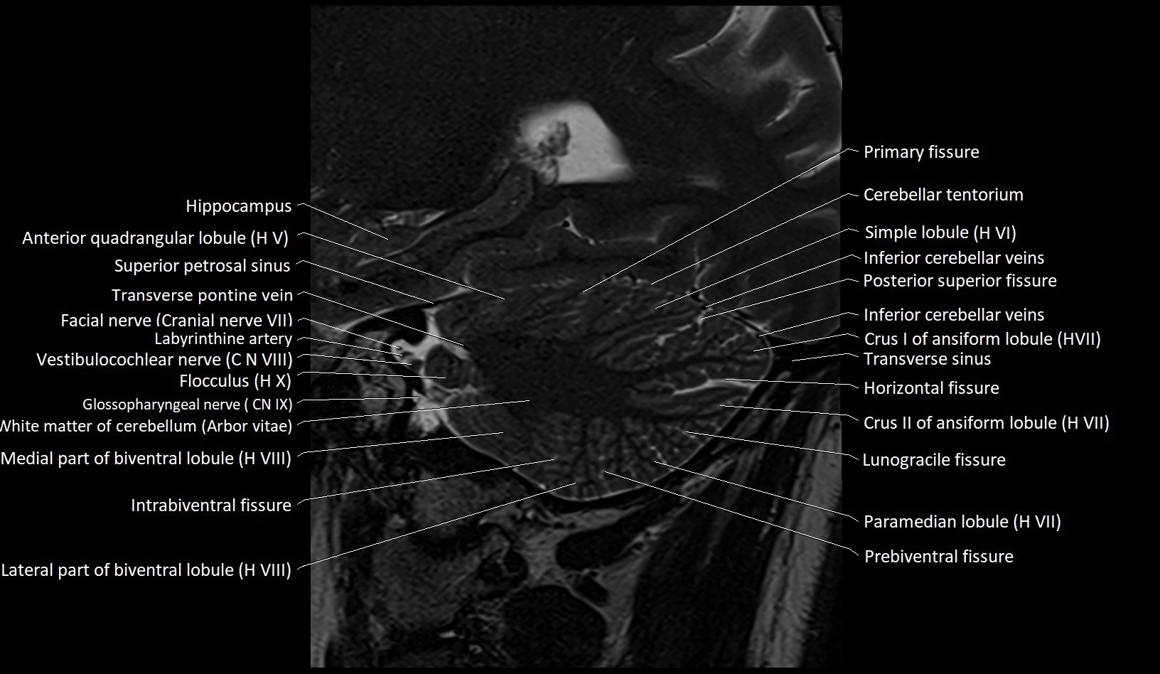 MRI Cerebellar anatomy sagittal High-resolution labelled image 17.webp